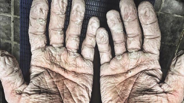 Ужасающая фотка олимпийского чемпиона по гребле, у которого руки теперь как у Билла Прихлопа
