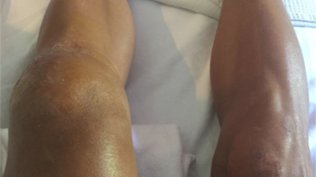 Mardi Gilbert a tenu à terminer l'étape après sa chute: sa rotule a triplé de volume