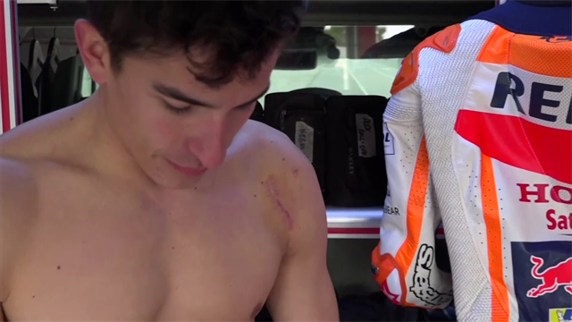 Marc Marquez mostra la cicatrice dopo l'intervento alla spalla sinistra operata a dicembre Marc Marquez mostra la cicatrice dopo l'intervento alla spalla sinistra operata a dicembre