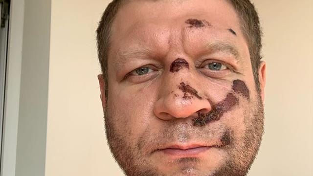 Емельяненко грохнулся с велосипеда и сорвал бой с Энрике