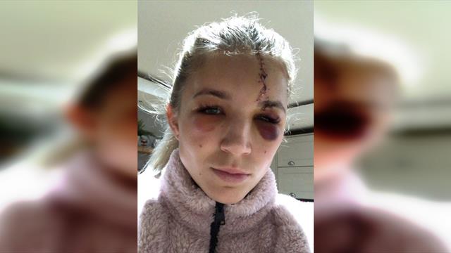 Вратарь женского «Ливерпуля» получила страшную травму: поперек лба – шов, под глазами – гематомы
