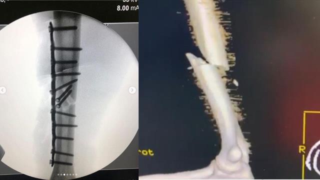¡Impresiona! La radiografía 3D que muestra el húmero de Márquez roto y su posterior reconstrucción ¡Impresiona! La radiografía 3D que muestra el húmero de Márquez roto y su posterior reconstrucción